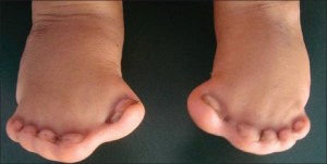 A rather extreme version of syndactyly. www.jisppd.com PMID: 21273726
